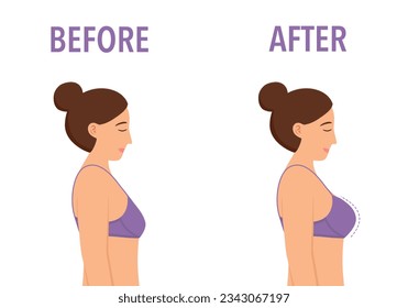 Female breast before and after plastic surgery in flat design on white background. svg
