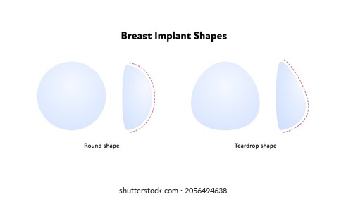 Female breast surgery infographic chart. Vector flat medical illustration. Set of blue round and teardrop implant type on white background.