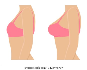 Female breasts in bra before and after augmentation. Woman before and after breast size correction. Plastic surgery concept. Vector illustration isolated on white background, side view profile.