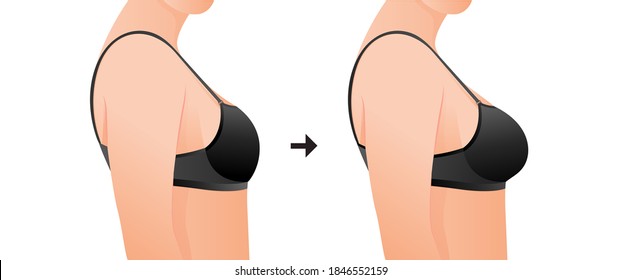 Female breasts in bra before and after augmentation/ breast size correction. Plastic surgery concept.woman body changing from overweight to slim as a result of training, dieting or breast implant. svg