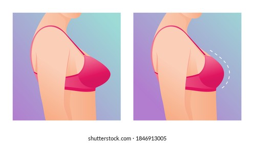 Female breasts in bra before and after augmentation/ breast size correction. Plastic surgery concept.woman body changing from overweight to slim as a result of training, dieting or breast implant.
