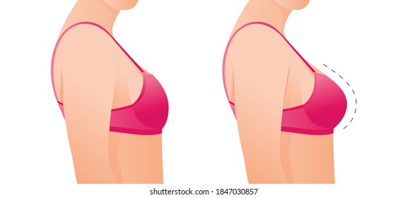 Female breasts in bra before and after augmentation/ breast size correction. Plastic surgery concept.woman body changing from overweight to slim as a result of training, dieting or breast implant.