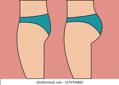 Female buttocks before and after correction of implants, changing shape of bottom with sports exercises, problem of flat ass. Vector illustration