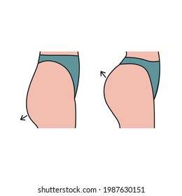 Female buttocks before and after correction of implants, changing shape of bottom with sports exercises, problem of flat ass. 