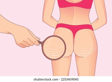 Female buttocks with stretch marks