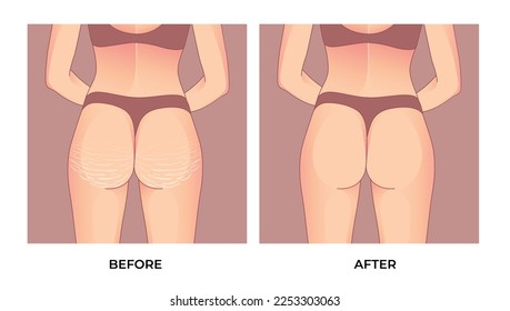 Female buttocks with stretch marks before and after  Brachioplasty, liposuction or plastic surgery, woman body shape transformation, Fat To Fit. 