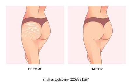 Female buttocks with stretch marks.Before and after weight loss.