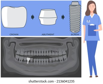 Female doctor talking about dental prosthesis structure. Implantation dentistry, stomatology. Tooth care, treatment. Dental implant creation scheme. Sequence of connection of screw, abutment and crown
