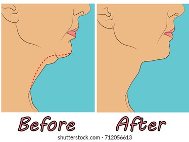 Female Double Chin Before After