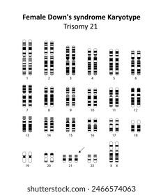 Síndrome de Down femenino (trisomía 21) cariotipo humano