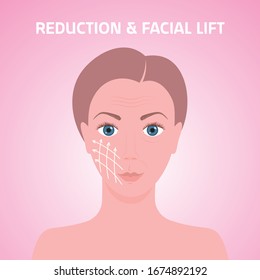 female face with marks arrow lines on skin for cosmetic medical procedures facial lift reduction treatment skincare removing wrinkles concept portrait vector illustration