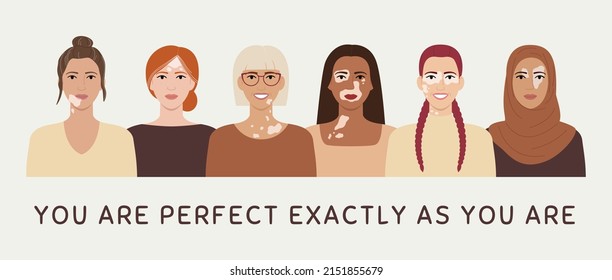 Female faces with vitiligo skin disease horizontal banner. You are perfect exactly as you are concept. Portraits with different ethnics, skin colors, hairstyles. Flat vector illustration