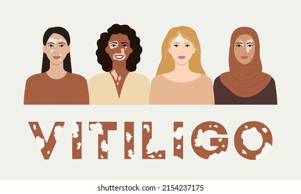 Female faces with vitiligo skin disease banner. World vitiligo day. Portraits with different ethnics, skin colors, hairstyles with vitiligo. Body positive concept. Flat vector illustration