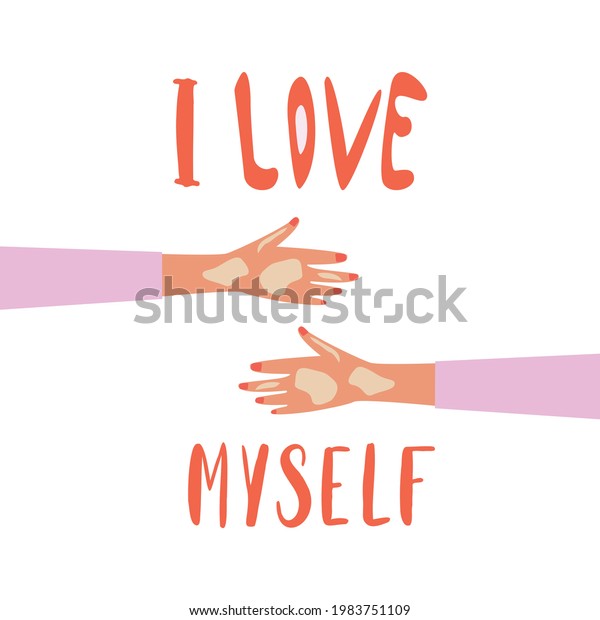 Female Fair Skin Hands Vitiligo Depigmantation Stock Vector (Royalty ...