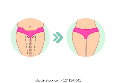 Female fat hips. Woman bottoms Flat design. Before and after. Woman buttocks vector illustration. Cellulite treatment program, weight loss.