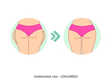 Las caderas grasas femeninas. La mujer traslada el diseño plano. Antes y después. La mujer nalgas ilustra el vector. Programa de tratamiento celular, pérdida de peso.