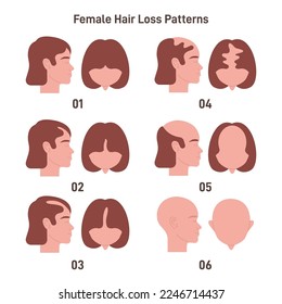 Female hair loss pattern set. Hair loss, balding process. Female alopecia. Flat vector illustration