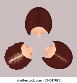 Female hair loss stages set. Top view portrait of a balding woman. Female alopecia pattern. Isolated vector illustration.