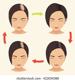 Female hair loss stages set. Woman before and after hair treatment and transplantation.  Baldness pattern cycle. Vector illustration.
