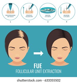 Female hair loss treatment with follicular unit extraction. Steps of FUE procedure. Alopecia infographic medical design template for transplantation clinics and diagnostic centers. Vector illustration