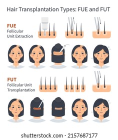 Female hair transplantation FUE and FUT, stages of Follicular Unit Extraction. Treatment of baldness, alopecia and hair loss. Vector medical infographic, woman's head scalp. Strip and graft machine.