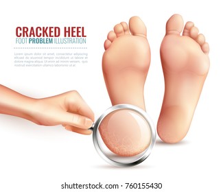 Female Hand With Magnifier Near Feet, Zoom Of Cracked Heels On White Background Vector Illustration