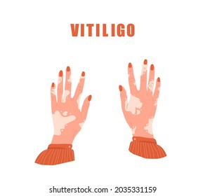Female hands with vitiligo. World vitiligo day. Skin disease. Self care and self love. Vector illustration in flat cartoon style.