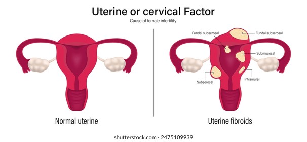 Female infertility vector. Comparison of normal uterine and uterine fibroids. Uterine factor. Leiomyoma. Subserous myoma, Intramural myoma and  Submucous myoma. Myoma Uteri.