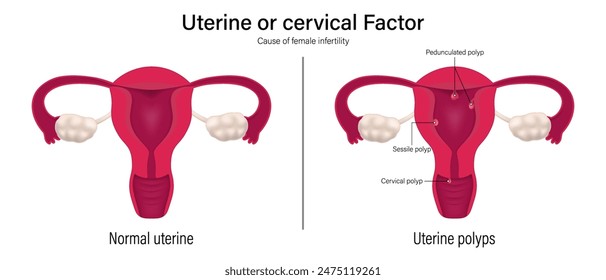 Female infertility vector. Comparison of normal uterine and uterine polyps. Uterine factor. Pedunculated, Sessile and Cervical polyp.