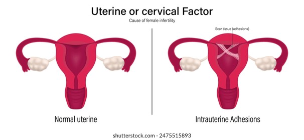 Female infertility vector. Comparison of normal uterine and intrauterine adhesions. Uterine factor. Asherman's syndrome.