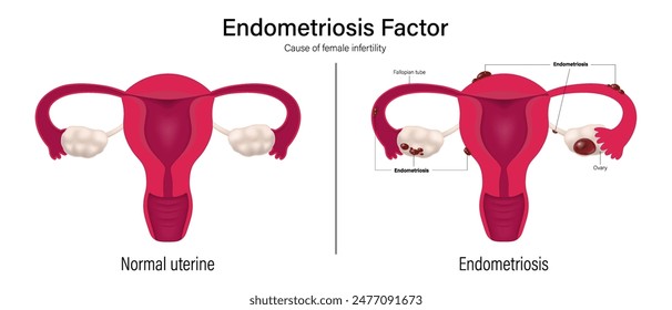 Vector femenino de infertilidad. Comparación de útero normal y endometriosis. Factor de endometriosis. Sistema reproductor femenino.