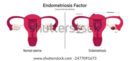 Female infertility vector. Comparison of normal uterus and endometriosis. Endometriosis factor. Female reproductive system.