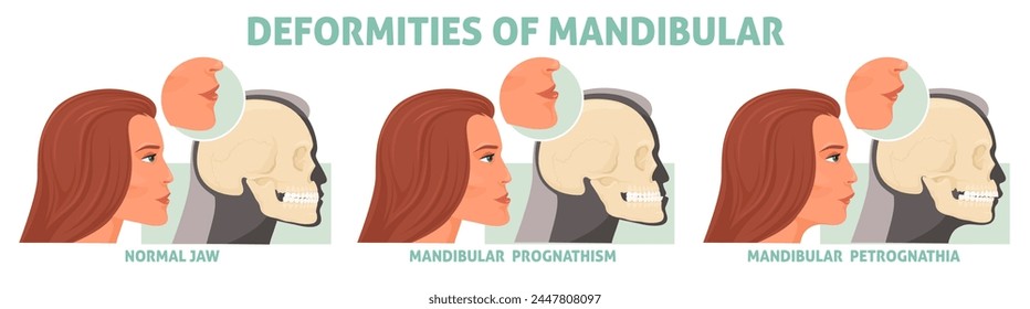 Female jaw deformities of mandibular medical poster vector illustration. Woman with normal face and abnormality. Dental defects reconstructive treatment advertisement