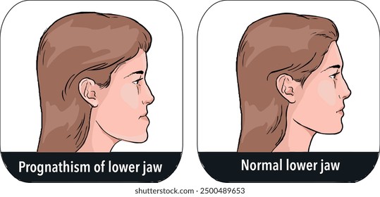 Female jaw deformities of mandibular medical poster