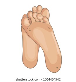 Female or male foot soles, barefoot. Foot bottom pathology: verruca, wart, papilloma virus. Many small warts on the sole and toe. Vector illustration, hand drawn cartoon style isolated on white.