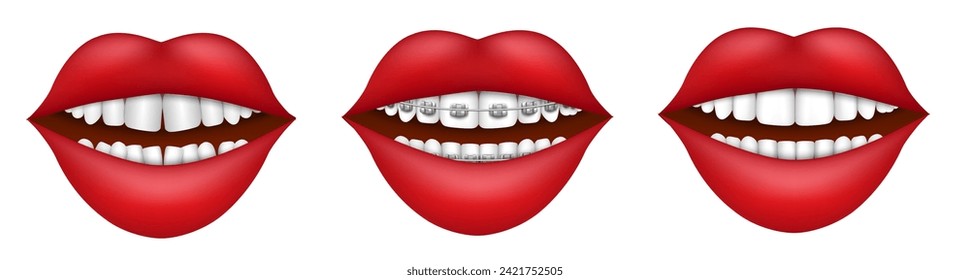 Female mouth with dental braces, crooked and straight teeth vector illustration. Medical corrective procedure of tooth aesthetic alignment and treatment