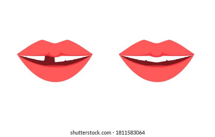 Female mouth, pink lips, white teeth, missing one tooth, toothless smile. Concept: tooth loss, extraction, dentistry. Vector illustration, flat cartoon design, isolated on white background, eps 10.