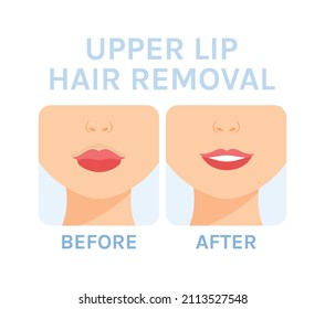 Female Mustache. Removal of Unwanted Hair above Lip. Depilation. Before After. Clean Skin and Smile on Face. Cartoon Color style. White background. Vector illustration for Beauty Cosmetology design.