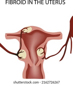 female organ tumor disease fibroid