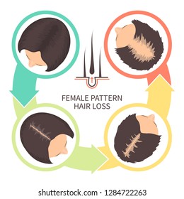 Female pattern hair loss set. Stages of baldness in women. Androgenetic alopecia infographic medical vector template for clinics and diagnostics centres.