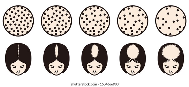 Female Pattern Hair Loss Set. Stages Of Baldness In Women.