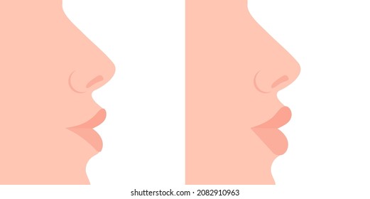 Female profile. Thin lips, plump lips. Plastic surgery, lip augmentation. Vector illustration, flat cartoon minimal design isolated on white background, eps 10.