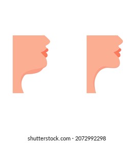 Female profile with and without a double chin. Before and after. Concept: face contour correction, face contouring, rejuvenation. Vector illustration, flat minimal cartoon design isolated.