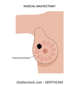 Female Radical Mastectomy Concept. Surgery To Remove Cancerous Tissue. Breast Cancer And Tumor In Woman Body. Patient Consultation Before Operation. Chest Anatomy Medical Isolated Vector Illustration.