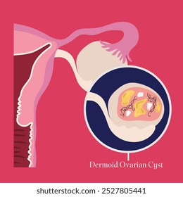 female reproductive system dermoid ovarian cyst illustration