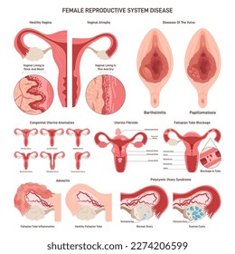 Female reproductive system disorder set. External and internal organs diseases. Urogenital inflamation, infection or sundrome. Gynecological medical diagnosis. Flat vector illustration