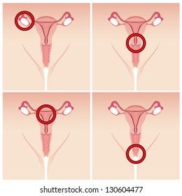 Female Reproductive System With Problems Vector Set