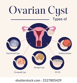 female reproductive system types of ovarian cyst illustration