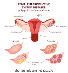 female reproductive system, the uterus and ovaries scheme, polycystic ovary syndrome, ovarian cyst