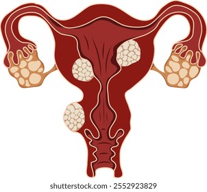 Enfermedad reproductiva femenina del útero o ilustración del fibroide uterino aislada en el fondo blanco